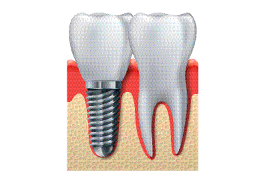 Elite Dental Club | Botox reg , Dental Fillings and Night Guards